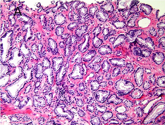 Prostatakarzinom 
Gleason-Pattern 3
Prostatakarzinom mit tubulärem Wuchsmuster